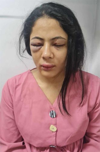 प्रहरी–शिक्षक झडपमा पत्रकार कार्कीको आँखामा पानीको फोहोरा, भिजन कम रहेको डाक्टरको भनाई